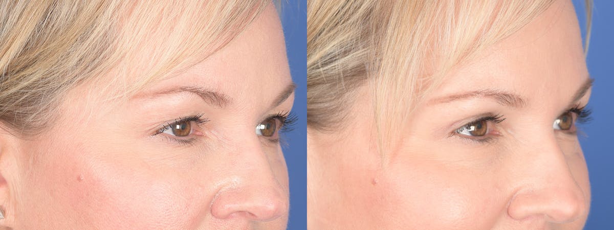 Blepharoplasty Before & After Gallery - Patient 320107 - Image 6