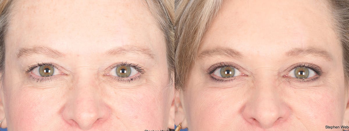 Blepharoplasty Before & After Gallery - Patient 238124 - Image 1