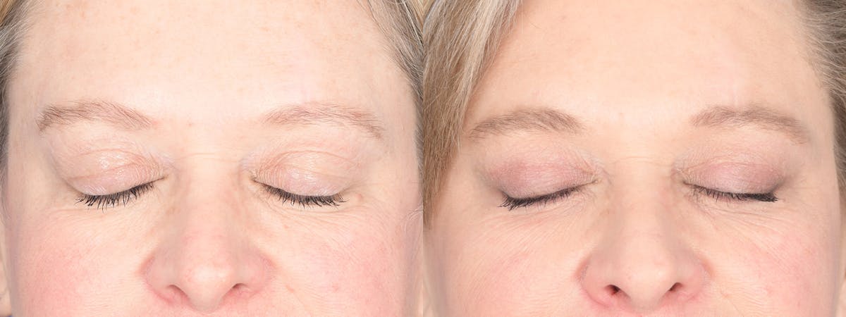 Blepharoplasty Before & After Gallery - Patient 238124 - Image 2