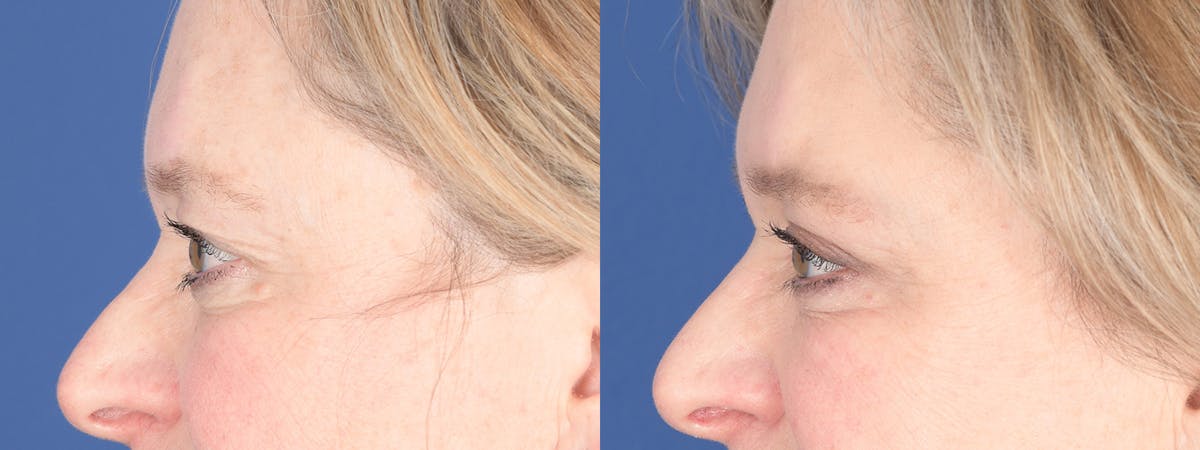 Blepharoplasty Before & After Gallery - Patient 238124 - Image 3