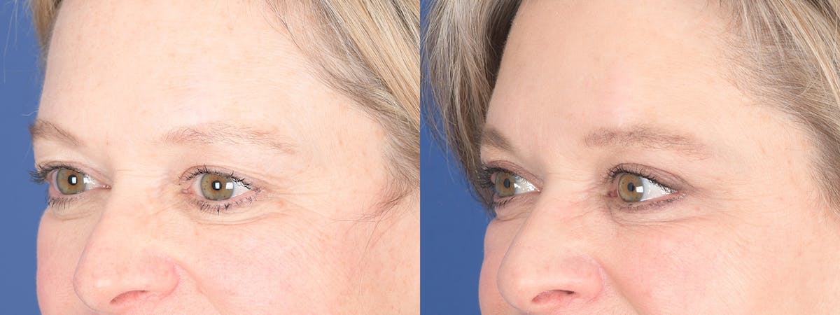 Blepharoplasty Before & After Gallery - Patient 238124 - Image 4