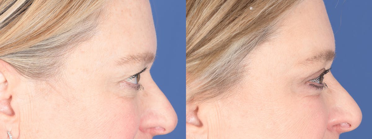 Blepharoplasty Before & After Gallery - Patient 238124 - Image 5