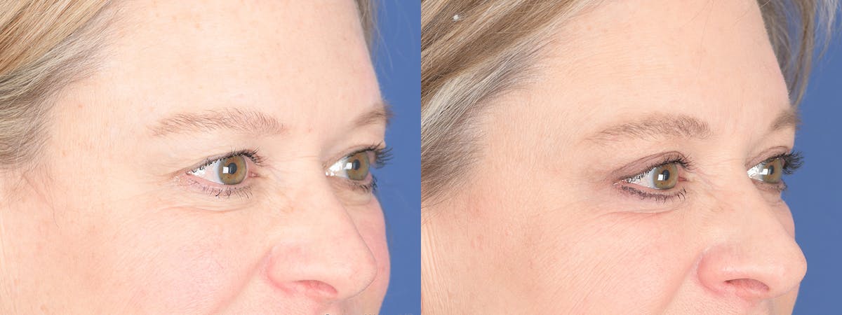 Blepharoplasty Before & After Gallery - Patient 238124 - Image 6