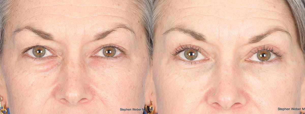 Fat Transfer Before & After Gallery - Patient 361871 - Image 1