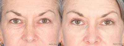 Blepharoplasty Before & After Gallery - Patient 347836 - Image 1