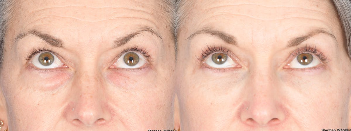 Fat Transfer Before & After Gallery - Patient 361871 - Image 2