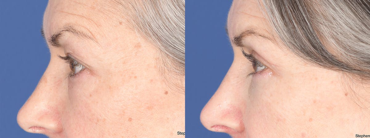 Fat Transfer Before & After Gallery - Patient 361871 - Image 3