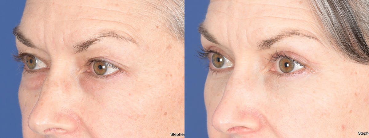 Fat Transfer Before & After Gallery - Patient 361871 - Image 4