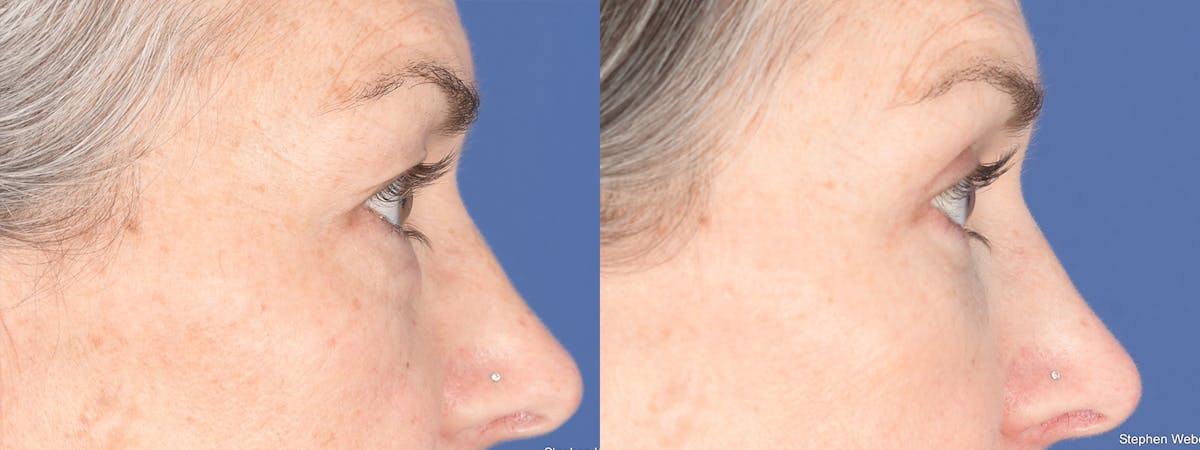 Fat Transfer Before & After Gallery - Patient 361871 - Image 5