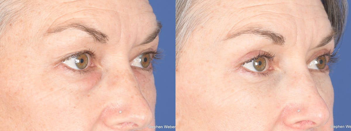 Fat Transfer Before & After Gallery - Patient 361871 - Image 6