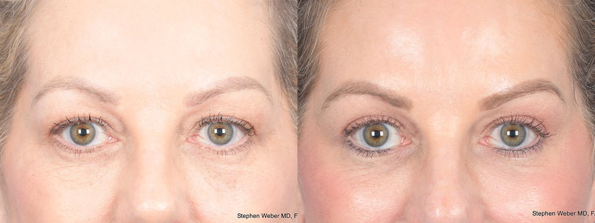 Blepharoplasty Before & After Gallery - Patient 206298 - Image 1