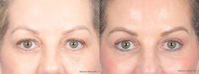 Blepharoplasty Before & After Gallery - Patient 206298 - Image 1
