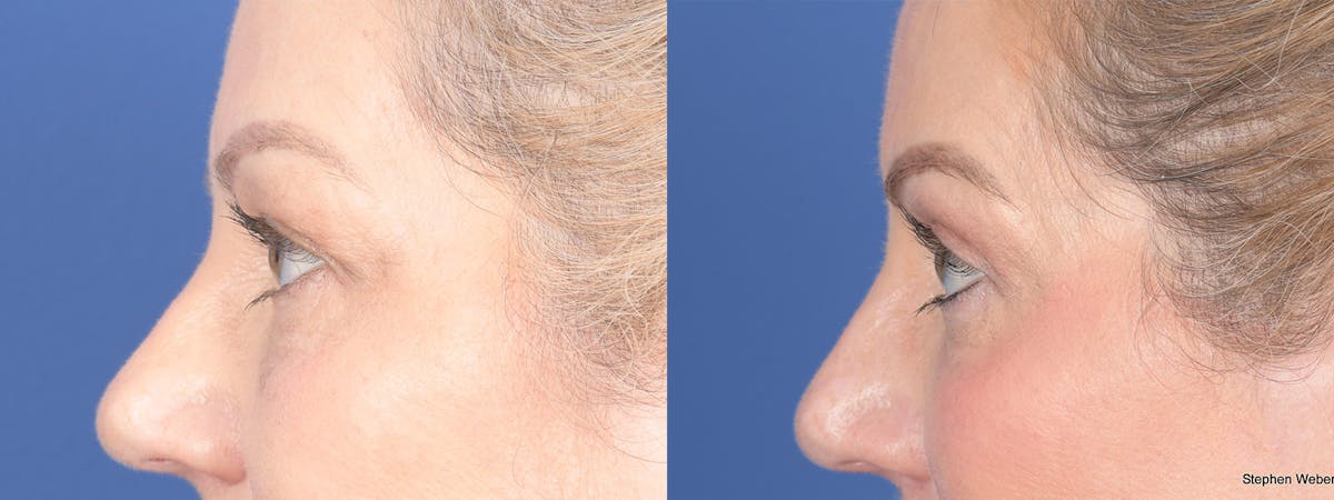 Blepharoplasty Before & After Gallery - Patient 206298 - Image 2
