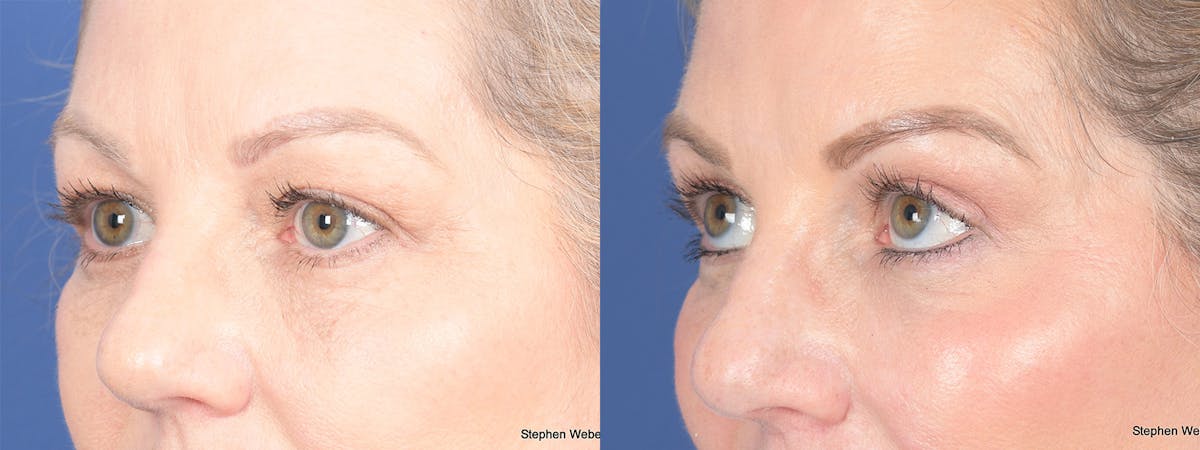 Blepharoplasty Before & After Gallery - Patient 206298 - Image 3
