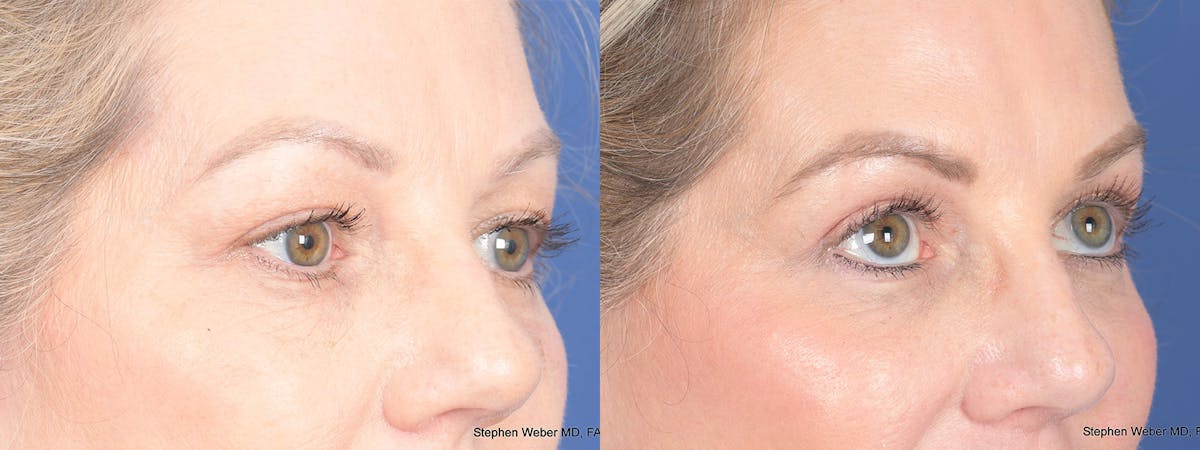 Blepharoplasty Before & After Gallery - Patient 206298 - Image 4