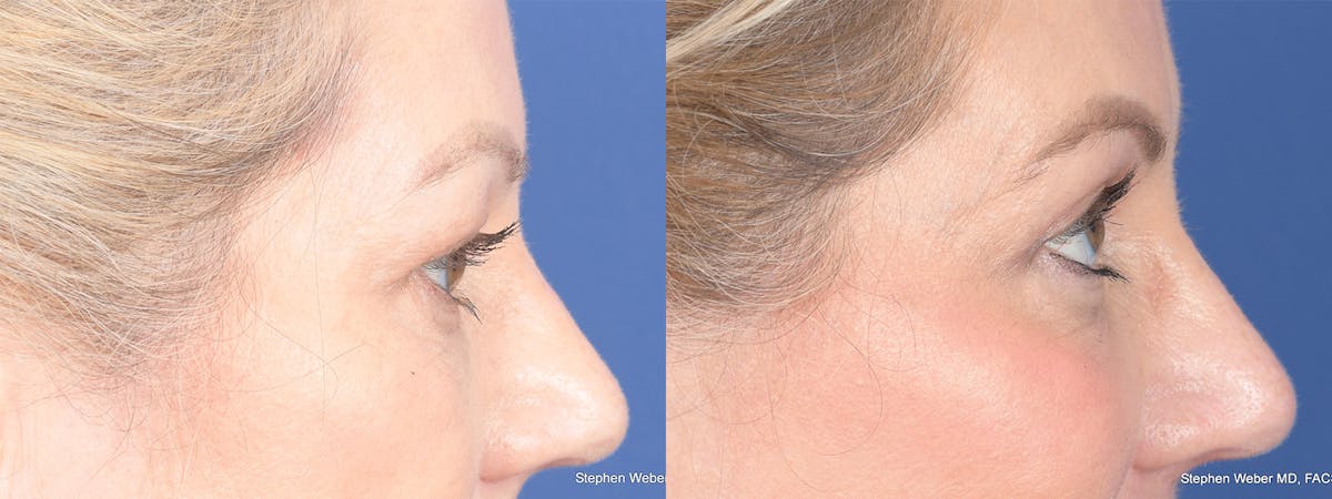 Blepharoplasty Before & After Gallery - Patient 206298 - Image 5