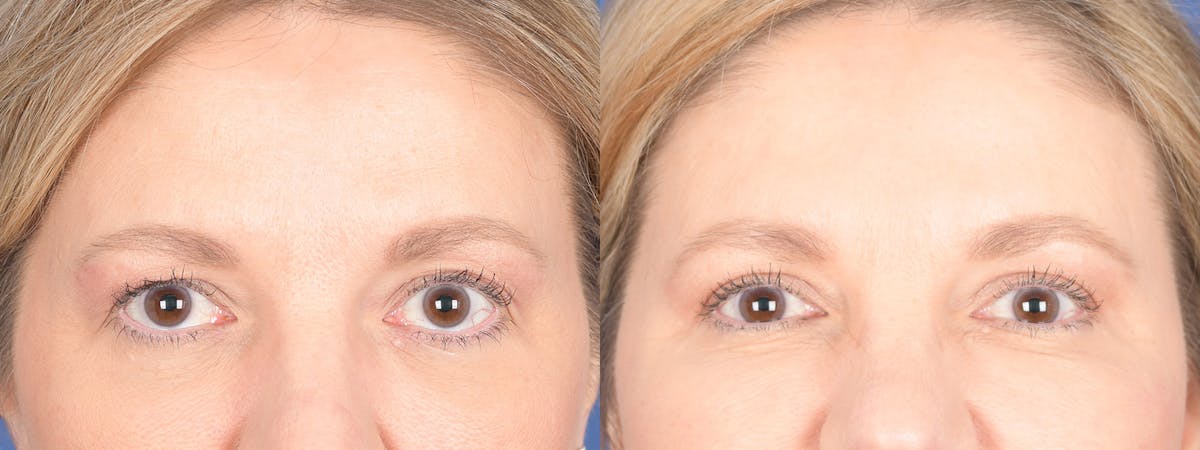 Blepharoplasty Before & After Gallery - Patient 328305 - Image 1