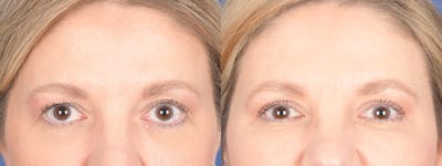 Blepharoplasty Before & After Gallery - Patient 328305 - Image 1