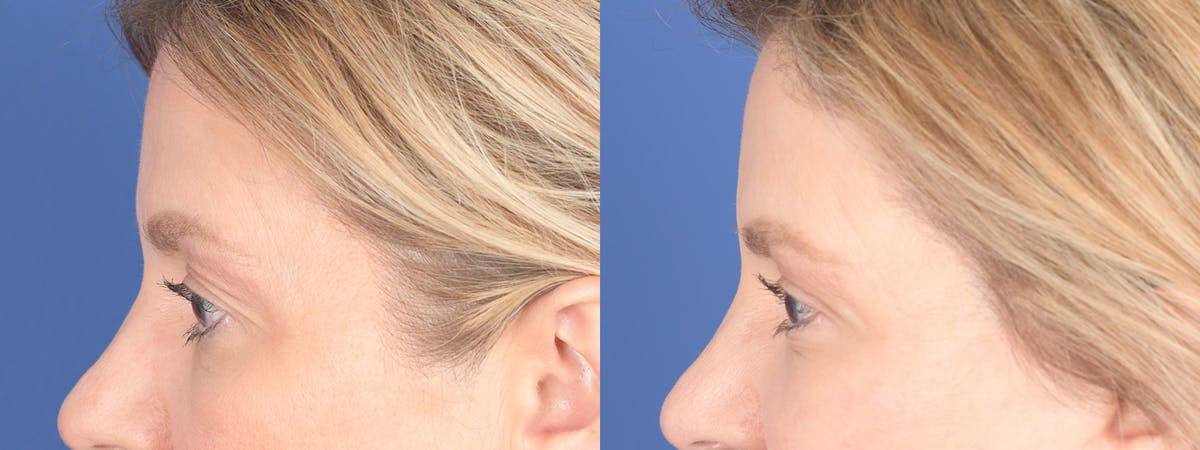 Blepharoplasty Before & After Gallery - Patient 328305 - Image 2