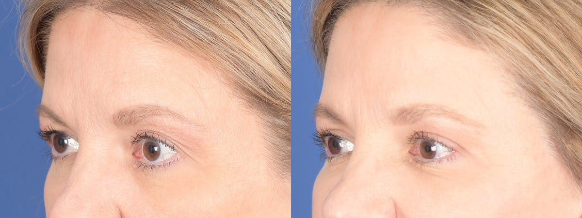 Blepharoplasty Before & After Gallery - Patient 328305 - Image 3