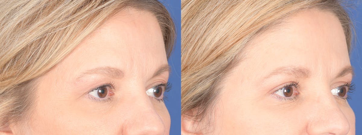 Blepharoplasty Before & After Gallery - Patient 328305 - Image 4