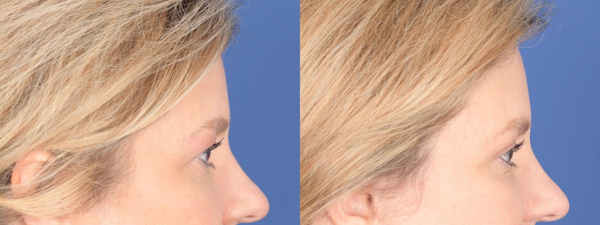Blepharoplasty Before & After Gallery - Patient 328305 - Image 5