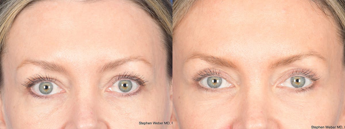 Blepharoplasty Before & After Gallery - Patient 226603 - Image 1