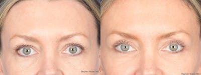 Blepharoplasty Before & After Gallery - Patient 226603 - Image 1