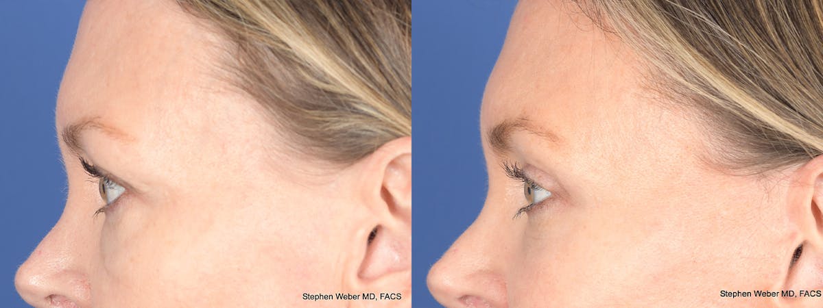 Blepharoplasty Before & After Gallery - Patient 226603 - Image 2