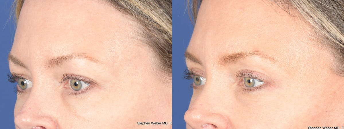 Blepharoplasty Before & After Gallery - Patient 226603 - Image 3