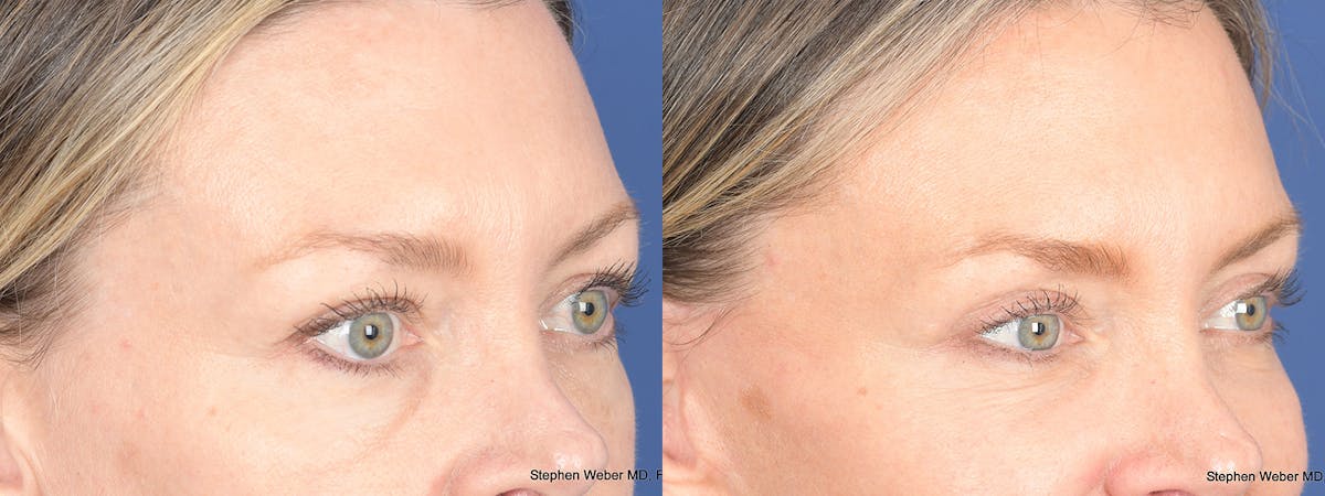 Blepharoplasty Before & After Gallery - Patient 226603 - Image 4