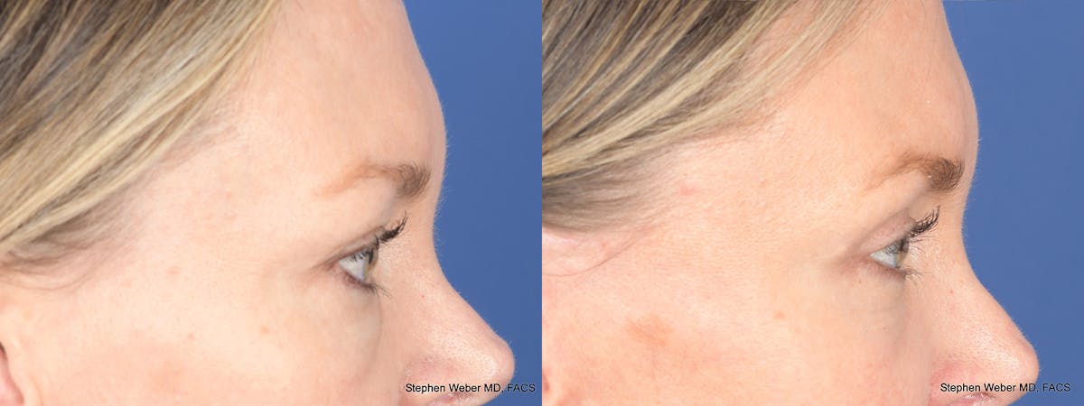 Blepharoplasty Before & After Gallery - Patient 226603 - Image 5