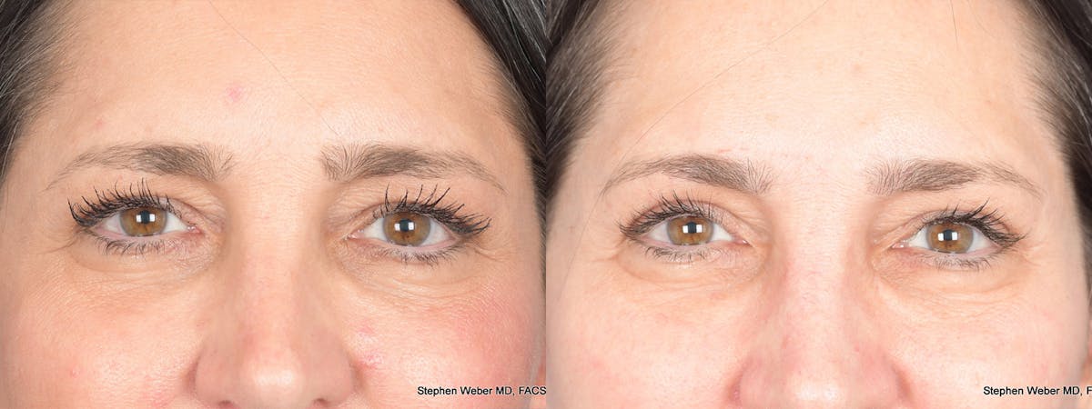 Blepharoplasty Before & After Gallery - Patient 175388 - Image 1