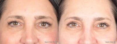 Blepharoplasty Before & After Gallery - Patient 175388 - Image 1