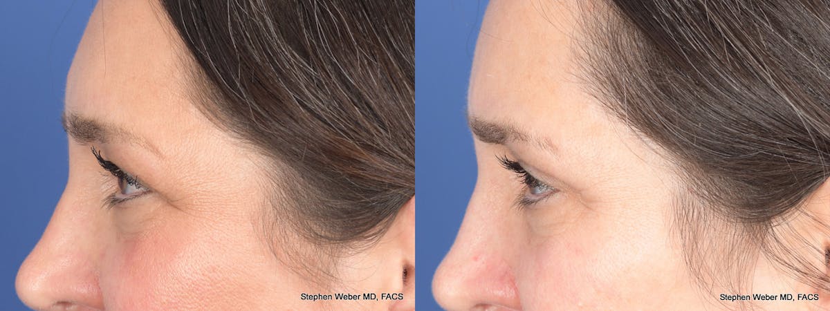 Blepharoplasty Before & After Gallery - Patient 175388 - Image 2