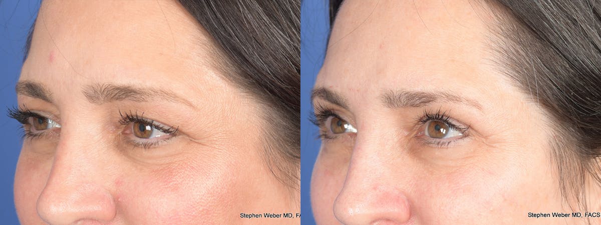 Blepharoplasty Before & After Gallery - Patient 175388 - Image 3