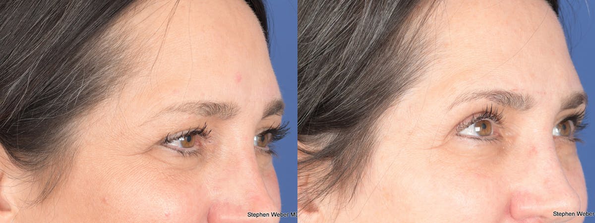 Blepharoplasty Before & After Gallery - Patient 175388 - Image 4