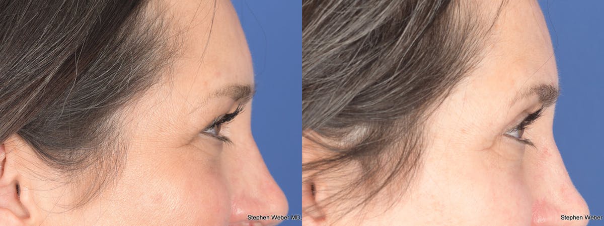 Blepharoplasty Before & After Gallery - Patient 175388 - Image 5