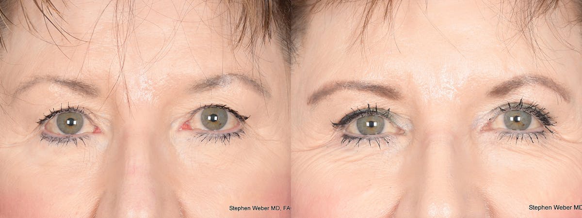 Blepharoplasty Before & After Gallery - Patient 148938 - Image 1