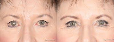 Blepharoplasty Before & After Gallery - Patient 148938 - Image 1
