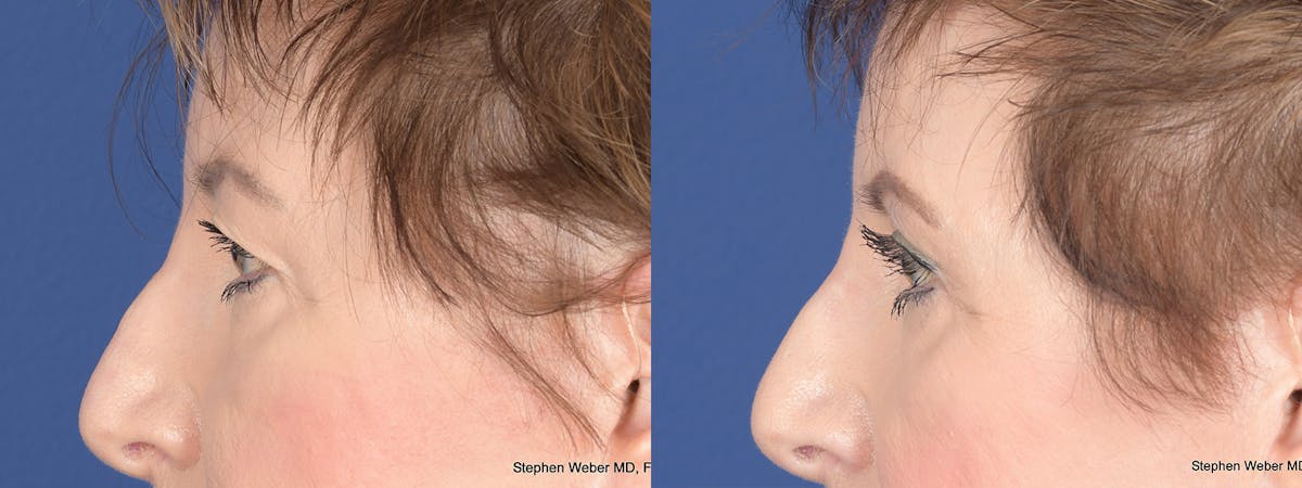 Blepharoplasty Before & After Gallery - Patient 148938 - Image 2