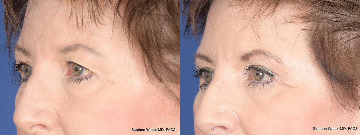 Blepharoplasty Before & After Gallery - Patient 148938 - Image 3