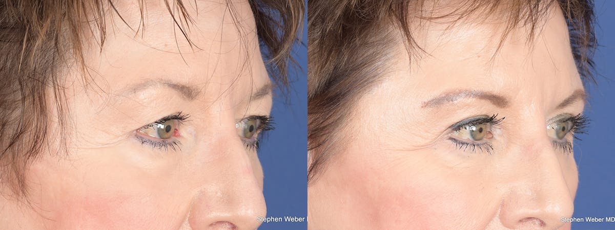 Blepharoplasty Before & After Gallery - Patient 148938 - Image 4