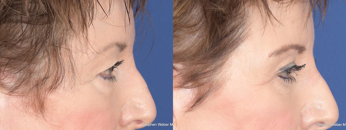 Blepharoplasty Before & After Gallery - Patient 148938 - Image 5