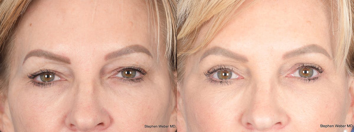 Blepharoplasty Before & After Gallery - Patient 172486 - Image 1