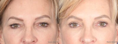 Blepharoplasty Before & After Gallery - Patient 172486 - Image 1