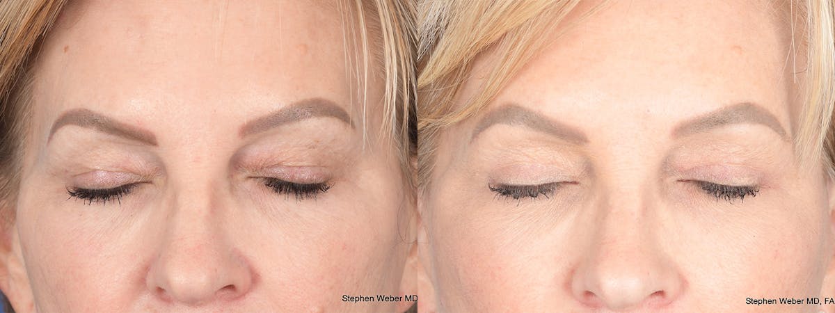 Blepharoplasty Before & After Gallery - Patient 172486 - Image 2