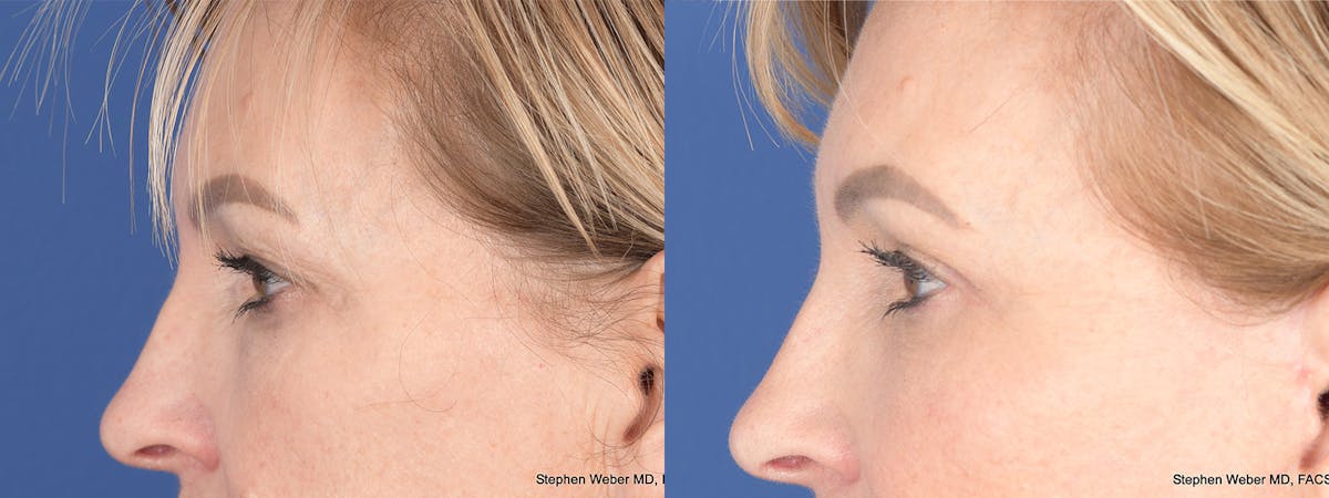Blepharoplasty Before & After Gallery - Patient 172486 - Image 3