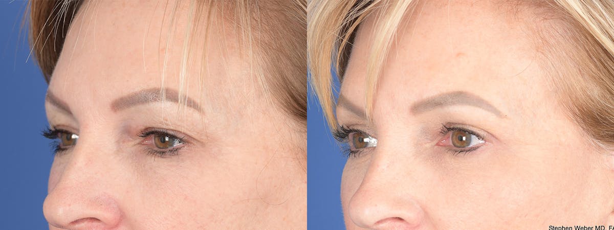 Blepharoplasty Before & After Gallery - Patient 172486 - Image 4