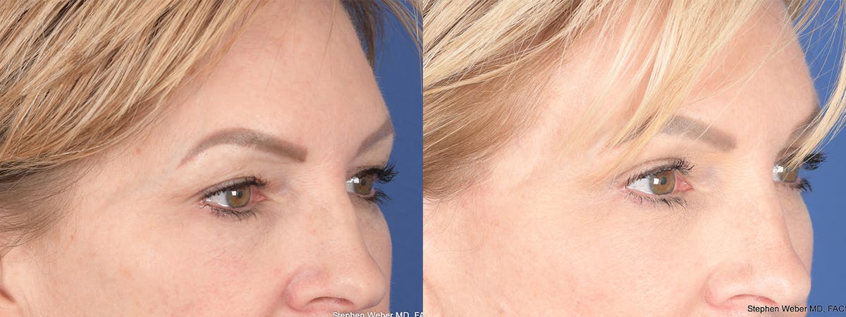 Blepharoplasty Before & After Gallery - Patient 172486 - Image 5